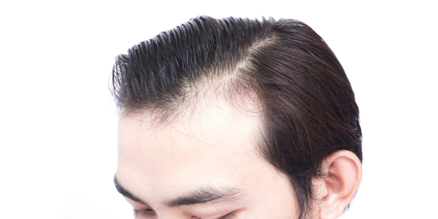 فراغات الشعر في مقدمة الرأس