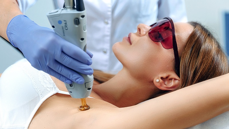 ليزر إزالة شعر الإبط