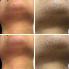 ليزر إزالة شعر الذقن