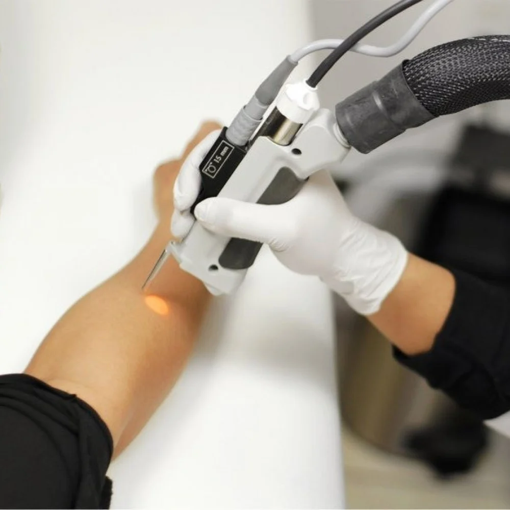 ليزر إزالة شعر اليدين