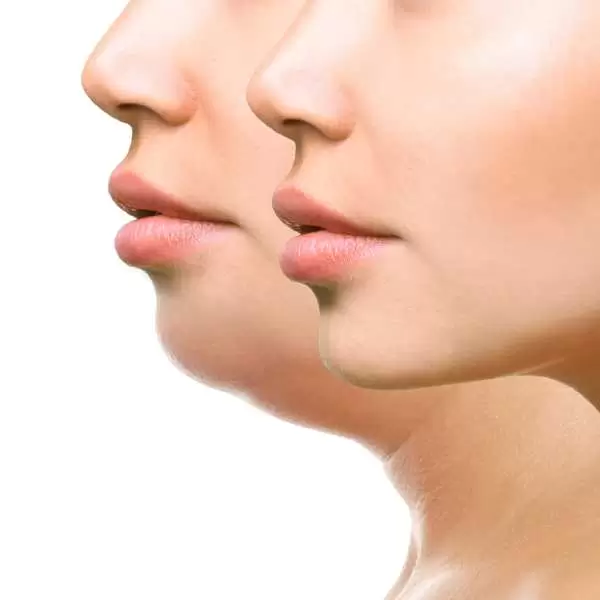 نحت الوجه بدون جراحة