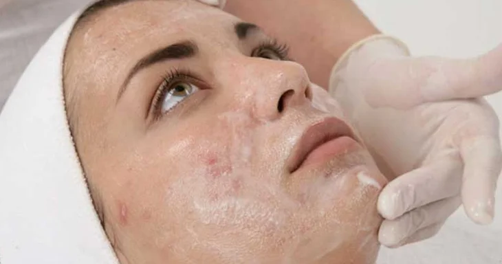 التقشير الكيميائى للوجه